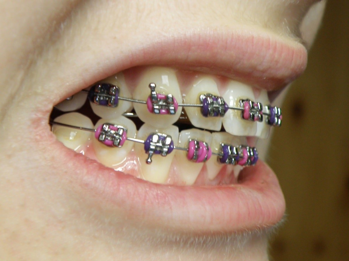 who invented braces